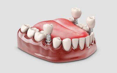 All-on-4 Dental Implants: How Many Teeth Can You Get?